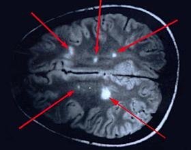 Cerebro esclerosis