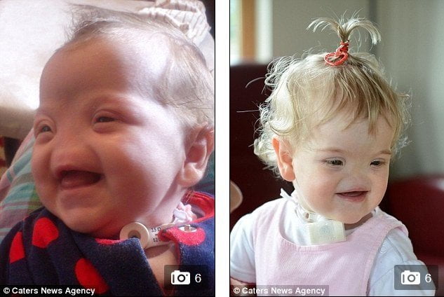 [VIDEO] Una niña que nació sin nariz pero siempre te regala una sonrisa
