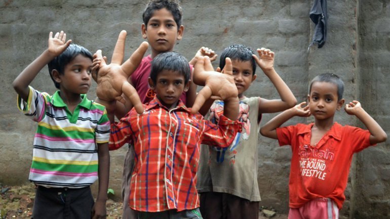 [FOTOS Barcroft India] El niño con manos gigantes que enfrenta al bullying en su colegio
