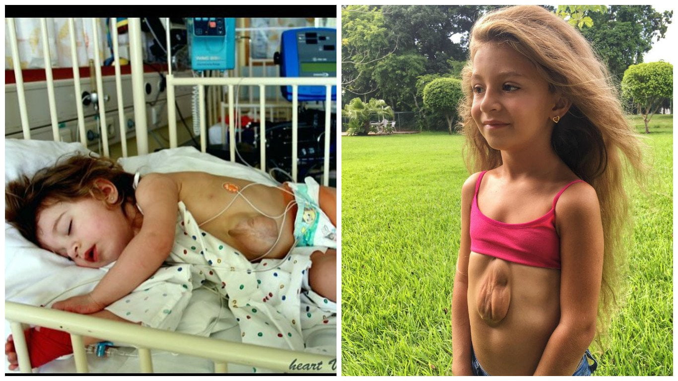 El impactante caso de la niña que nació con el corazón fuera del pecho y cuenta su historia en Instagram