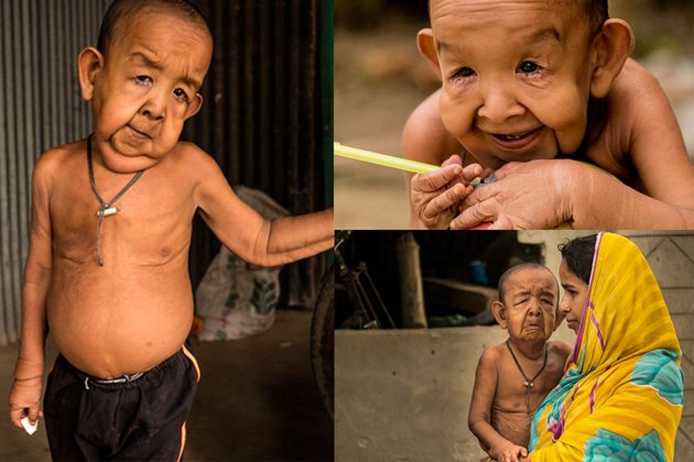 El verdadero Benjamin Button: tiene 4 años pero parece de 80