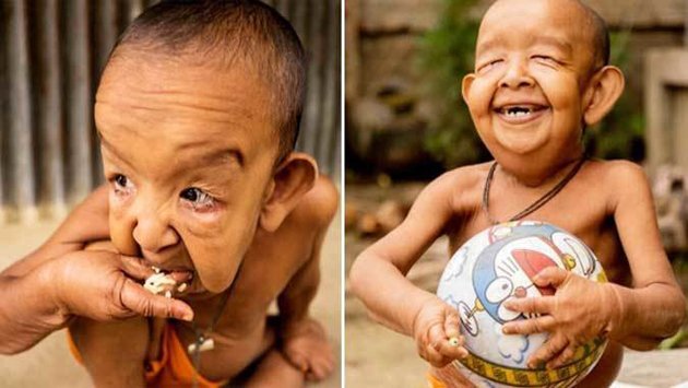 El verdadero Benjamin Button: tiene 4 años pero parece de 80