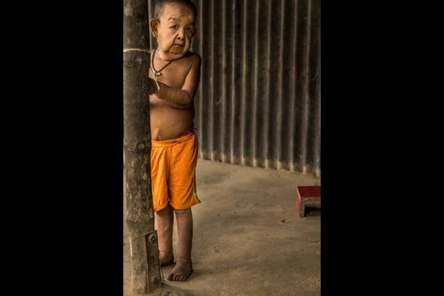 El verdadero Benjamin Button: tiene 4 años pero parece de 80