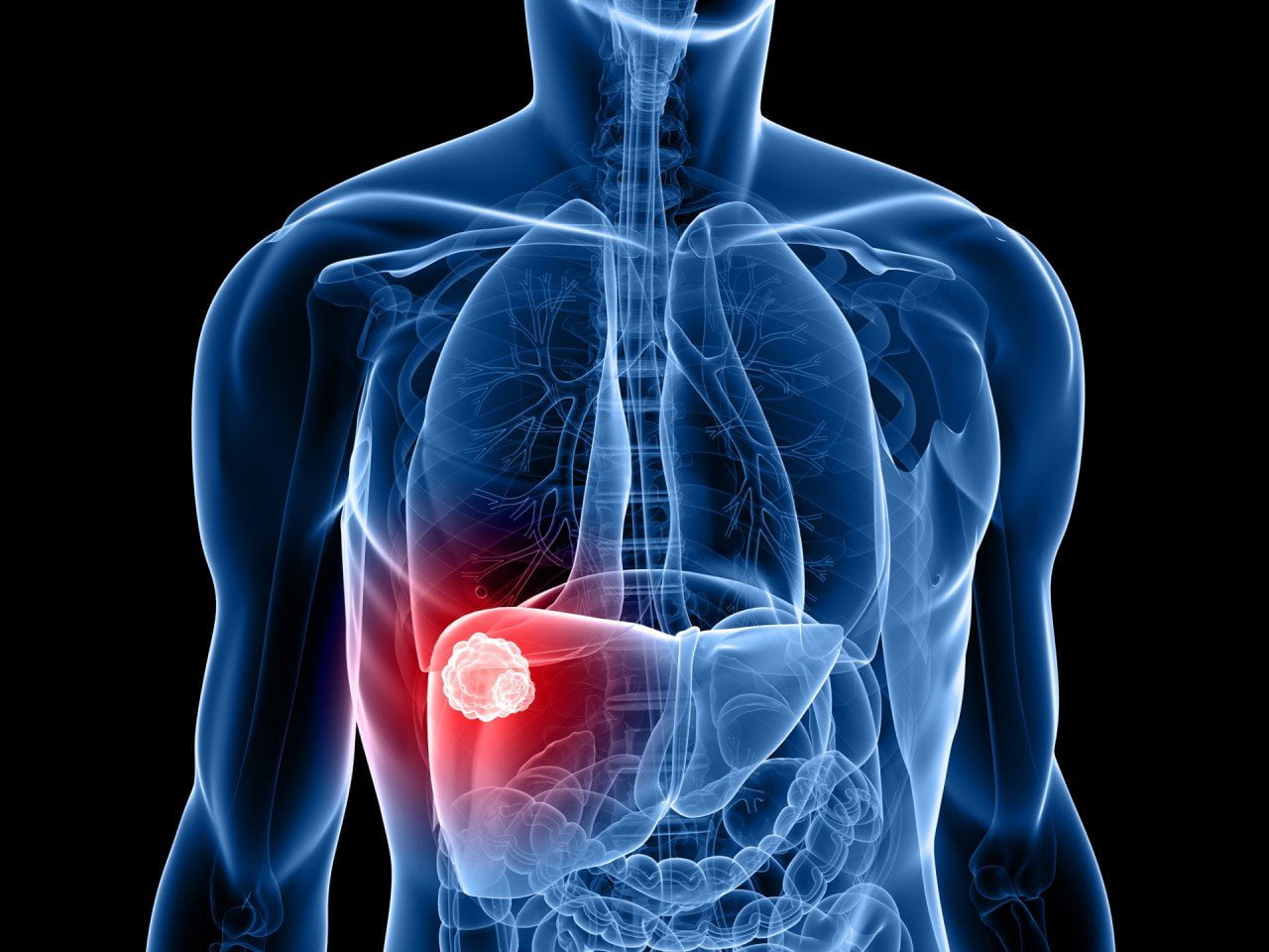 Hay casos remotos de transmisión de cáncer post trasplante de órganos