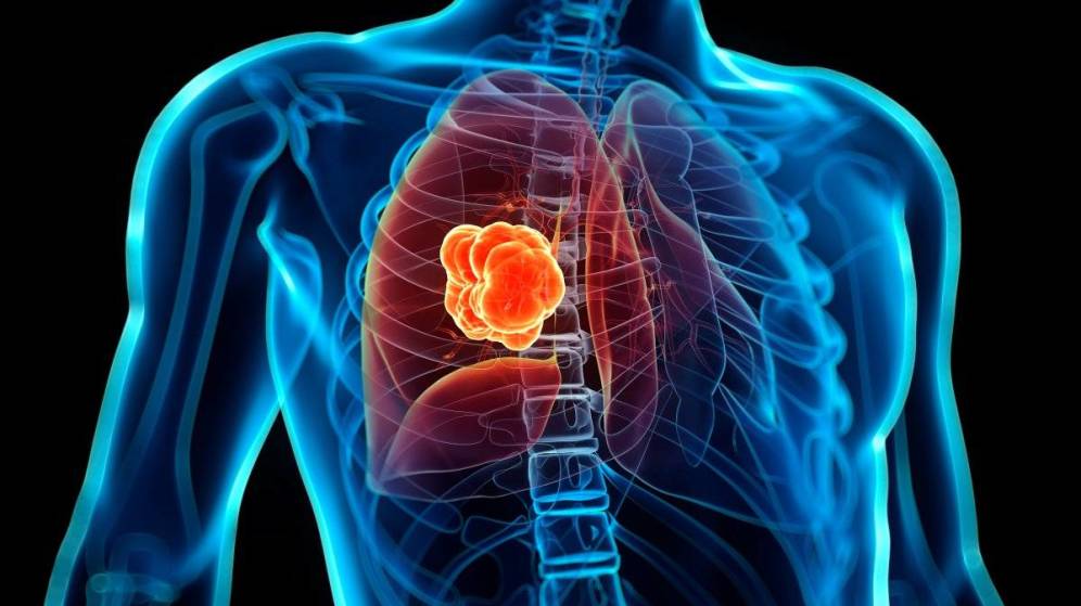 Fumadores tienen riesgo de hasta 20 veces más de cáncer al pulmón