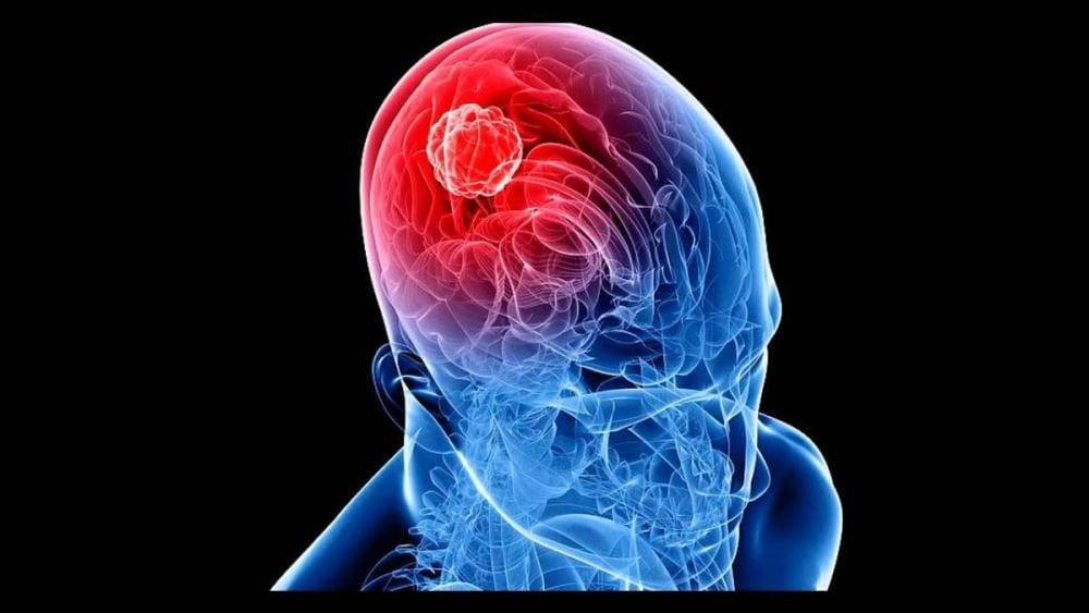 Cáncer de cerebro: ¿Es posible sobrevivir a este mal?