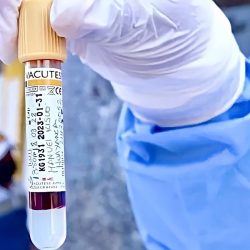 Cáncer de próstata: Examen de sangre y de tacto rectal son complementarios para un mejor diagnóstico